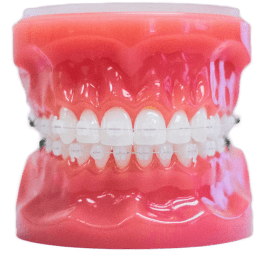 clear braces on model
