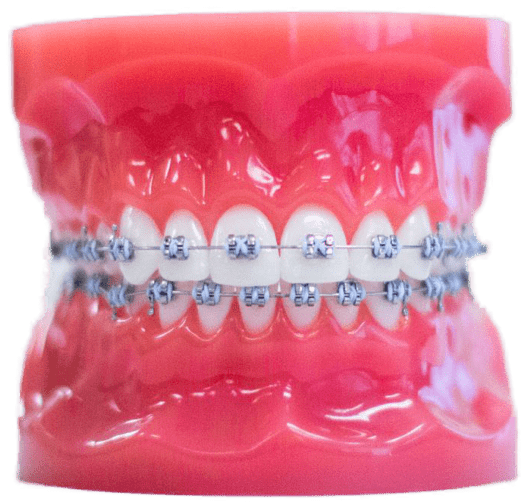 metal braces on model